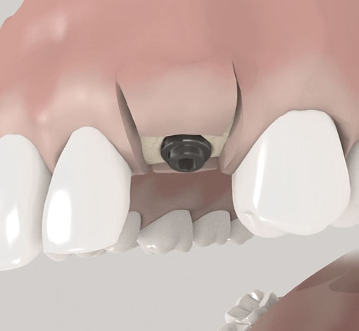 Implantate im einem Schritt