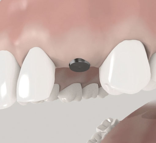 Implantate in zwei Schritten