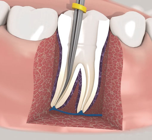 Wurzelkanalbehandlung